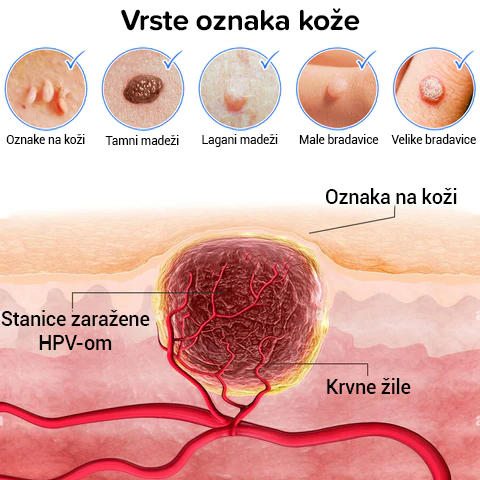 Liečivé krémy na kožné škvrny, znamienka a bradavice